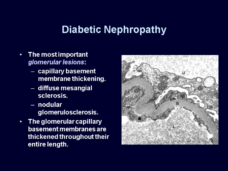 Diabetic Nephropathy The most important glomerular lesions: capillary basement membrane thickening. diffuse mesangial sclerosis.